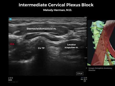 Intermediate Cervical Plexus Block