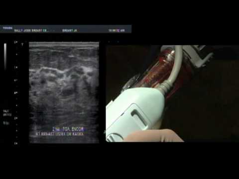 SenoRx EnCor ® Ultrasound Vacuum Assisted Biopsy