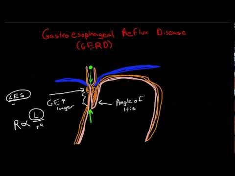 Pathophysiology of Gastroesophageal Reflux Disease (GERD)