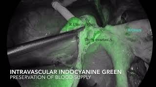 Endometriosis surgery with vascular preservation for fertility