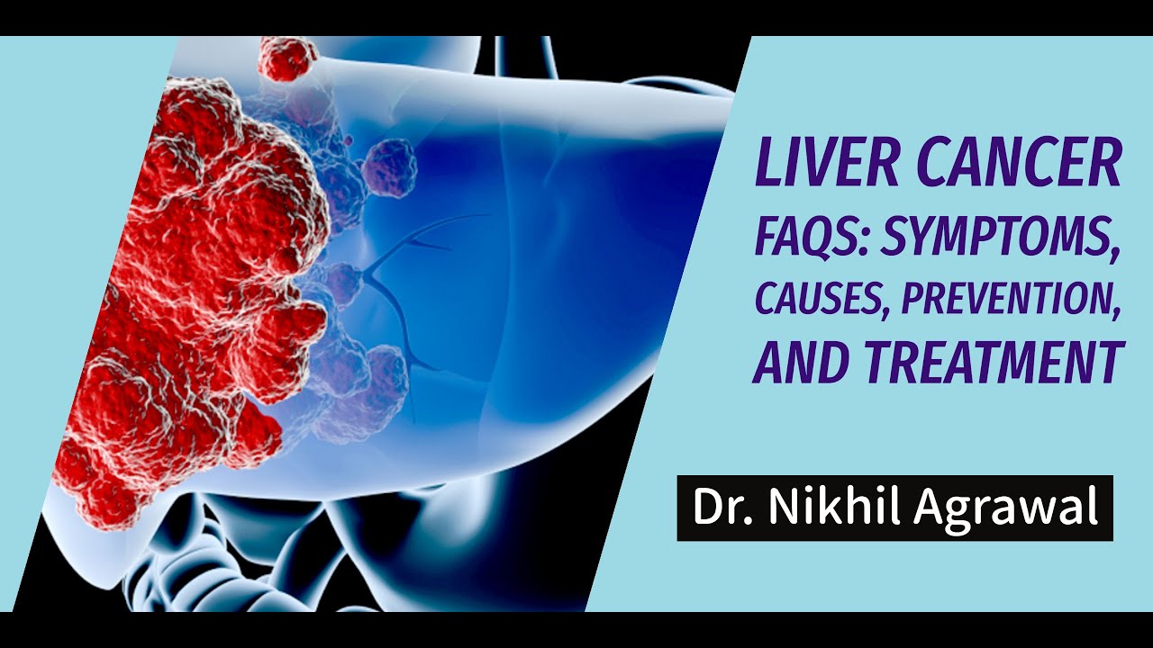 Liver Cancer FAQs: Symptoms, Causes, Prevention, and Treatment | Dr. Nikhil Agrawal