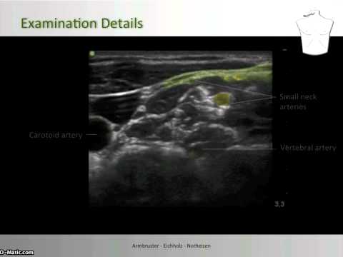 Cervical Plexus Block - Nerve Localization