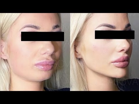 experimental feminine lower face reconstruction ⋅˚ ୨୧﹙1X﹚