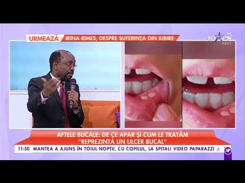 Sintomi del papilloma virus in bocca