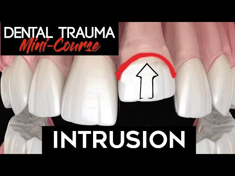 Dental Trauma Mini-Course - Part 8 - Dental Trauma Guide - Intrusion Injury