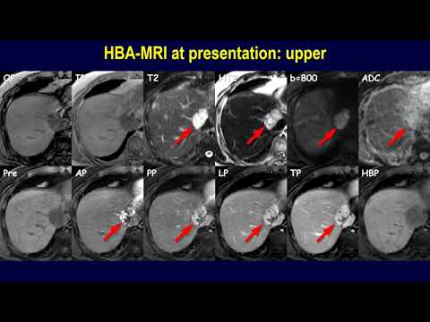 Tricky case: Is this a hepatic hemangioma? - Contrast pooling lesion in chronic hepatitis B
