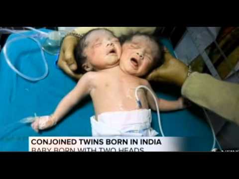 'Baby Having 2 Heads' Born in India | Woman in India gives birth to 'baby with two heads'