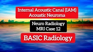 Download lagu Internal Acoustic Canal {IAM}Acoustic Neuroma - MRI Case - Neuro Radiology mp3