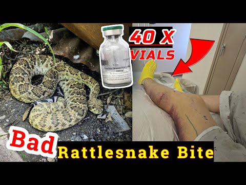 Rattlesnake Bite While Herping Central Texas
