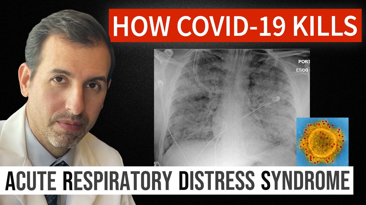 How Coronavirus Kills: Acute Respiratory Distress Syndrome (ARDS) & COVID 19 Treatment