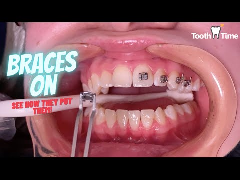 How do they put braces on - Tooth Time Family Dentistry New Braunfels