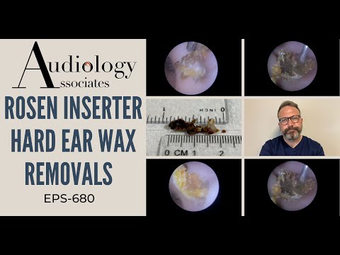 ROSEN INSERTER HARD EAR WAX REMOVALS - EP680