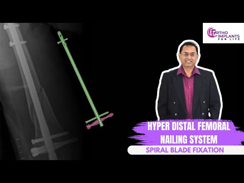 Hyper DFN Nailing System Spiral Blade Fixation Procedure