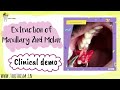 CLINICAL DEMO OF EXTRACTION OF MAXILLARY 2ND MOLAR