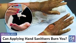 Can Applying Hand Sanitisers Burn You?
