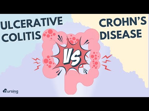 Inflammatory Bowel Disease- Ulcerative Colitis vs. Crohn's Disease