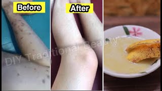 How To Get Rid Of Dark Spots On Legs Fast With Banana || Natural Remedies
