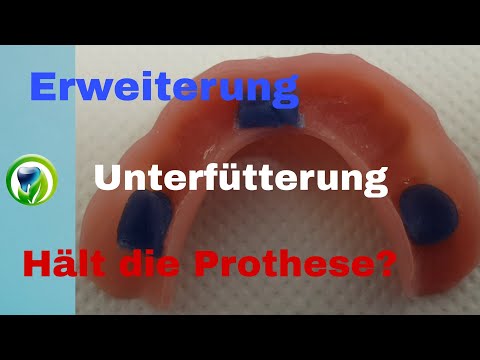 Erweiterung und Unterfütterung einer Unterkiefer Totalprothese - Saugt die Prothese immer?