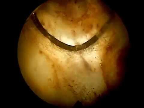 Steine in der Prostata Symptome Foto Nach der Bestrahlung für Prostatakrebs