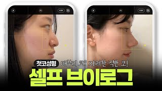 매부리코 → 자려한 직반코  #코성형 ㄹㅇ 찐 후기