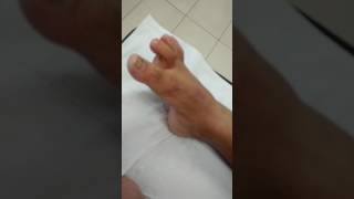 Tenodesis dinámica tendon flexor largo del hallux