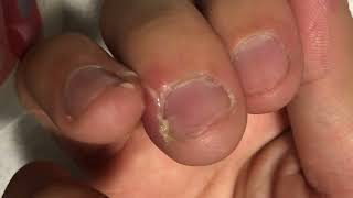【閲覧注意】指の膿を、出してみたら……part2