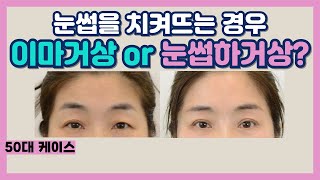 겹쌍꺼풀 고민? 해결 방법 알려드려요!