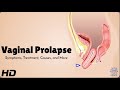 Vaginal Prolapse 101 What Every Woman Should Know