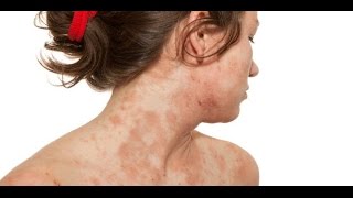 How To Get Rid Of Eczema Forever | Eczema Dermatitis Rash Treatment 2015