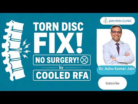 Watch video on Intradiscal RFA-Biacuplasty