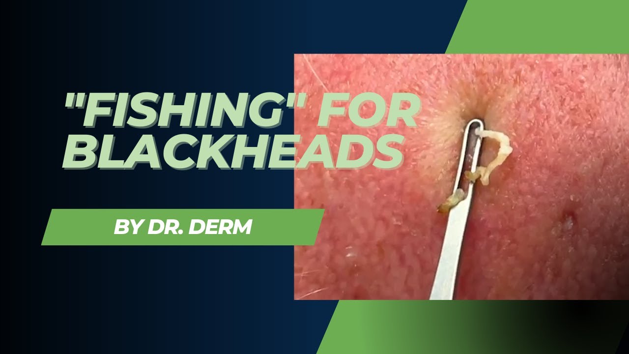 "Fishing" for Blackhead | Dr. Derm