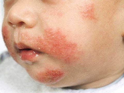 Dermatite di atopic lfk Dal quale i prodotti là possono essere leczema