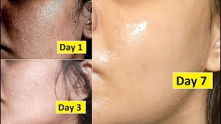 Skin Repair | Close Large OPEN PORES in 1 week, Remove Dark Spots, Anti Aging