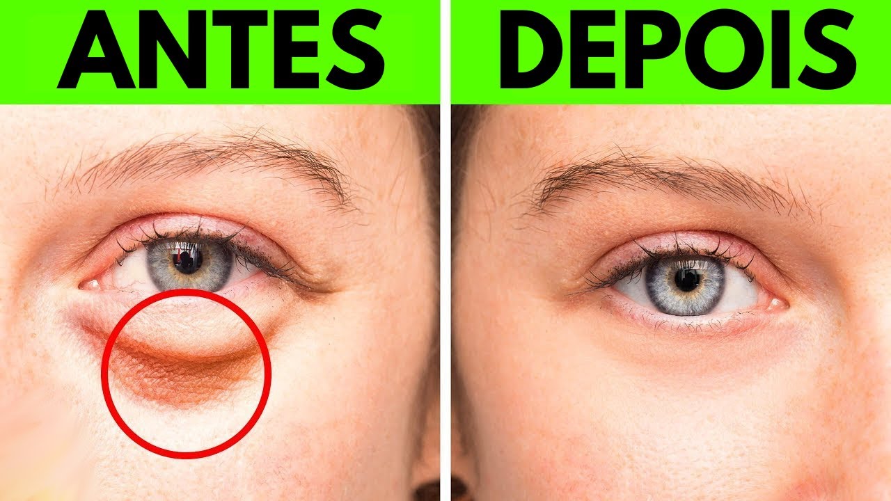 Livre-se das Bolsas nos Olhos com esses 17 remédios caseiros