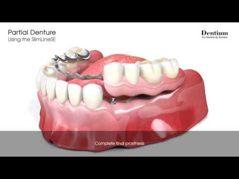 Partial denture