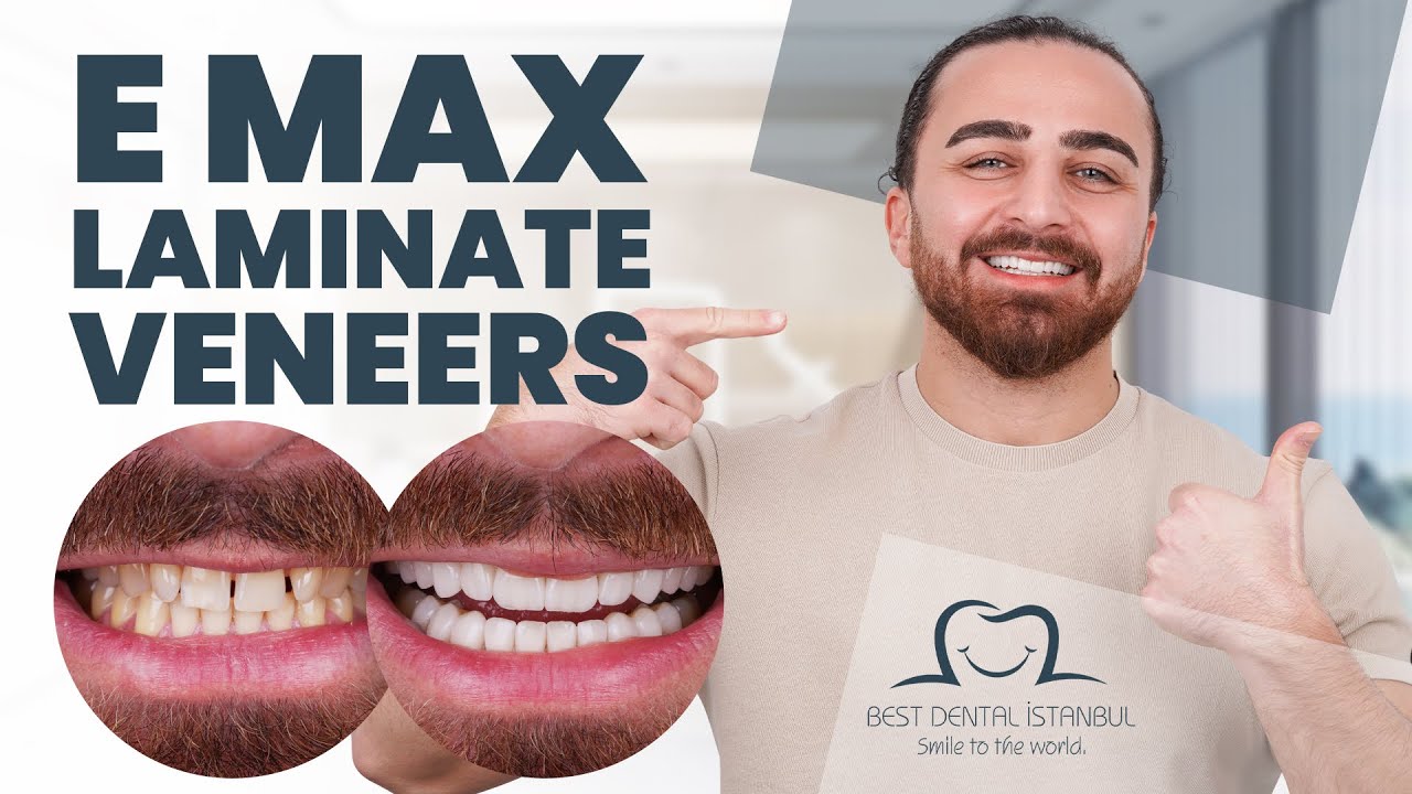 "Transforming My Smile in Istanbul: Journey with Best Emax Veneers! 🦷😁 | Hassan Cho's Dental Experience"