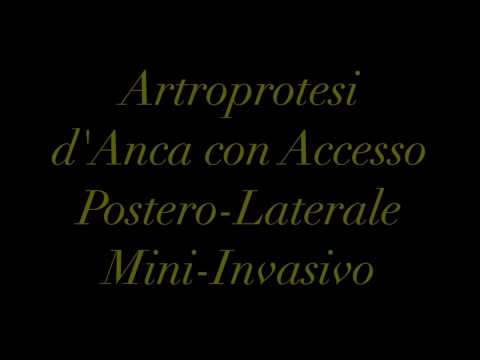 Sali di articolazioni sopportano grasso Artrosi deformante step 1 hip