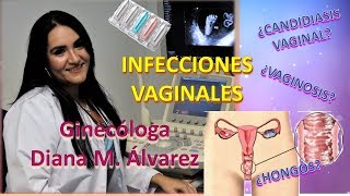 INFECCIONES VAGINALES - FLUJOS VAGINALES ANORMALES POR GINECÓLOGA DIANA ALVAREZ