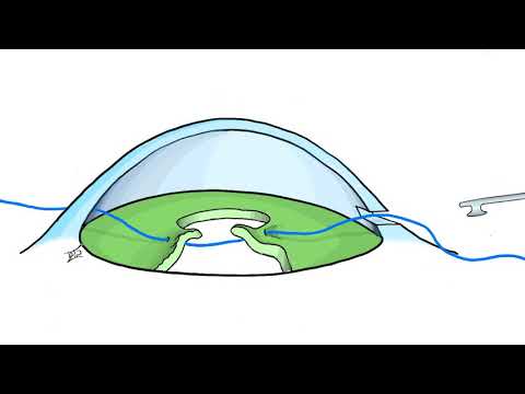 Single Pass Four Through Pupilloplasty - SFT using Seipser technique