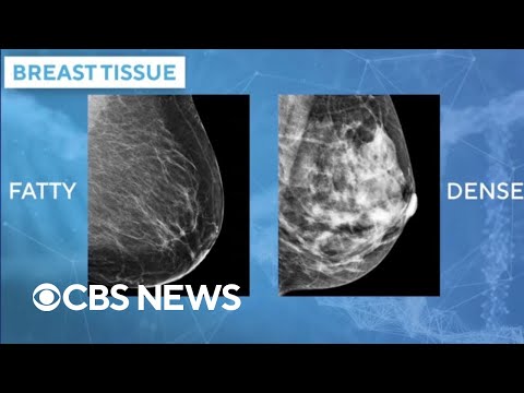 Doctors using AI mammogram readings to predict breast cancer risk