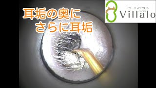 耳掃除動画vol.82「耳垢の奥にさらに耳垢」
