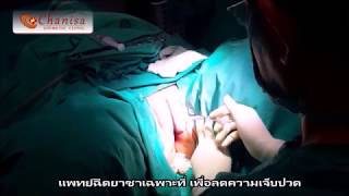 เลาะซิลิโคนเหลวบริเวณแคมใหญ่