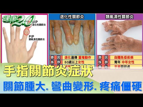 尾指彎曲