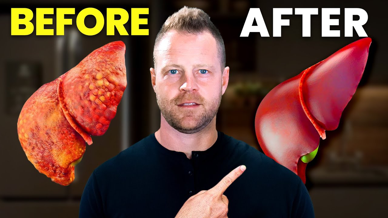 How to Fix Your Fatty Liver at Home...5 Tips