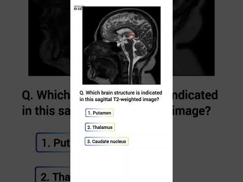 🧠 Radiology Quiz: Can You Identify This Brain Structure? 🧠