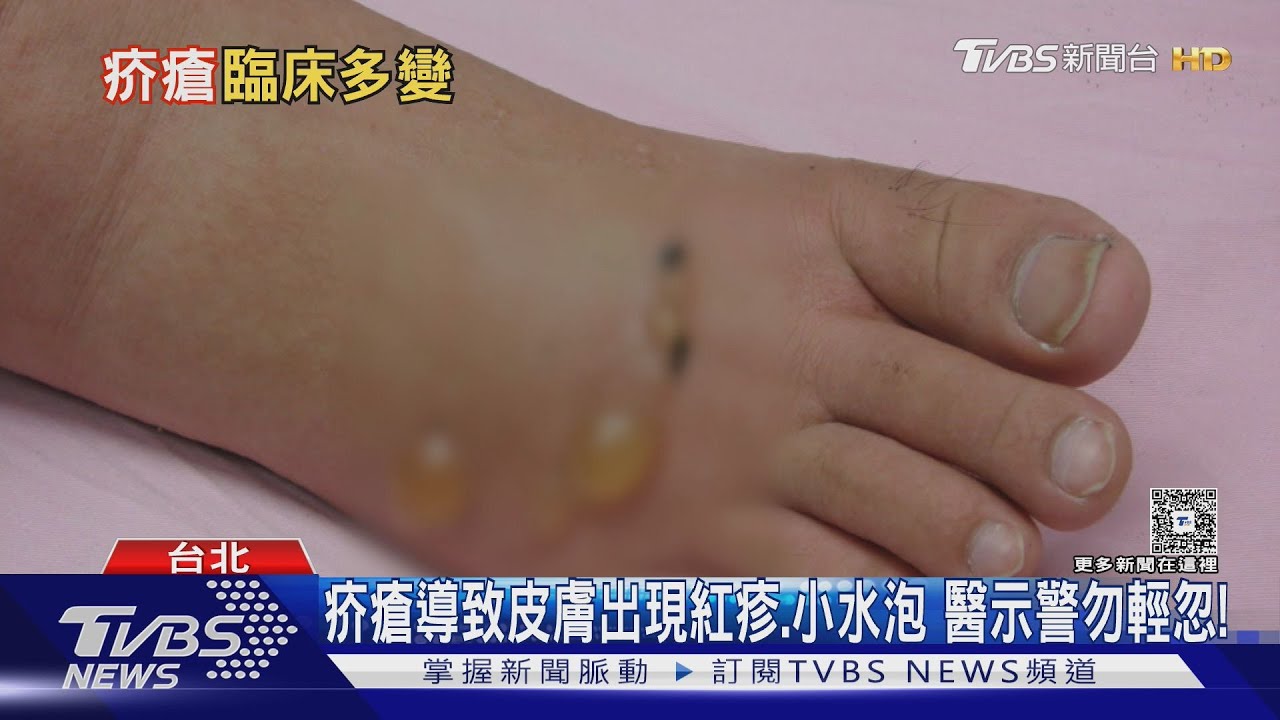 1人中鏢全家遭殃!染上「這疾病」夜間發作超崩潰