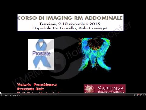 Prostata con calcificazioni