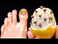 Cure Toenail Fungus For Under 1 Removes Fungi Like An Eraser