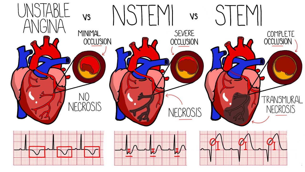 Acute Coronary Syndrome (Heart Attack) - Unstable Angina vs NSTEMI vs STEMI | With ECGs