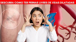 Segredo revelado: Tratamento eficaz para varizes